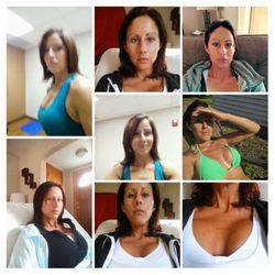 Parkins Plastic Surgery - Breast Augmentation done by Dr. Maida Parkins