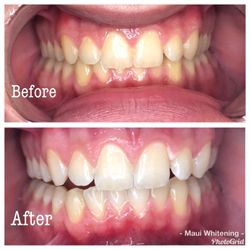 Maui Teeth Whitening And Tanning