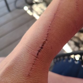 NextCare Urgent Care, Aurora - My arm the next day. - Urgent Care Near Me - Aurora, Colorado NextCare Urgent Care, Aurora - My arm the next day. - Urgent Care Near Me - Aurora, Colorado