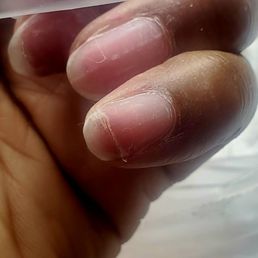 Broken painful nail