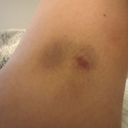 Labcorp - Photo showing bruising and discoloration on my arm following a blood draw performed at this clinic.