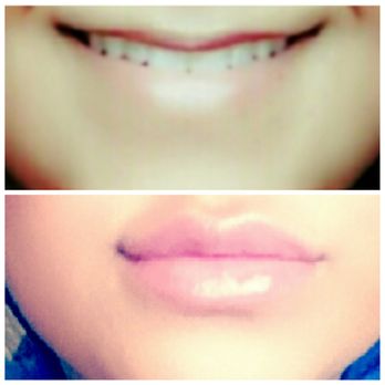 Texas Laser & Aesthetics Training Academy - This are my results for the lip filler. Katie has done an amazing job - Cosmetology Schools Near Me - Austin, Texas Texas Laser & Aesthetics Training Academy - This are my results for the lip filler. Katie has done an amazing job - Cosmetology Schools Near Me - Austin, Texas