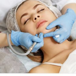 Merinaz - Microdermabrasion treatment