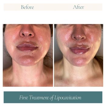 Vela Beauty Lab - Before & After Face & Neck Tightening - Skin Care Near Me - Lafayette, California Vela Beauty Lab - Before & After Face & Neck Tightening - Skin Care Near Me - Lafayette, California