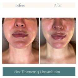 Vela Beauty Lab - Before & After Face & Neck Tightening