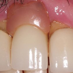 Dentistry on Officers Row - Massive gum loss on 3 front teeth