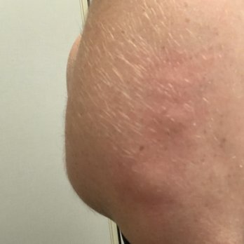 Hampton Inn & Suites McKinney - 3 Bed bug bites on my arm - Hotels Near Me - Mckinney, Texas Hampton Inn & Suites McKinney - 3 Bed bug bites on my arm - Hotels Near Me - Mckinney, Texas