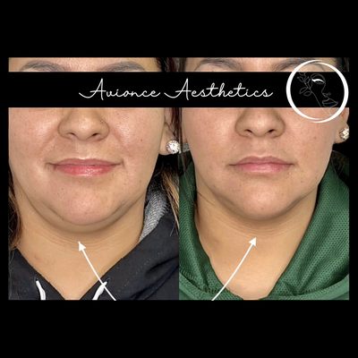 Kybella - Refine your neckline and remove unwanted fat. Kybella is the only FDA approved, permanent treatment for dissolving undesired fat cells under the chin