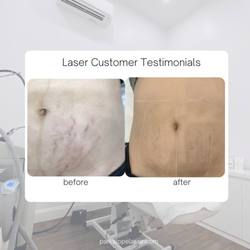 Park Slope Laser Aesthetic Center - stretch mark removal progress  using laser.