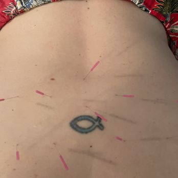 Kokin Healing Center - Acupuncture in my lower back for sciatic pain. - Acupuncture Near Me - Calabasas, California Kokin Healing Center - Acupuncture in my lower back for sciatic pain. - Acupuncture Near Me - Calabasas, California
