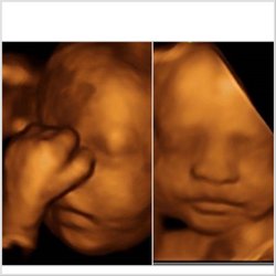 Babyvue 3D/4D ultrasound