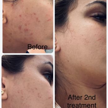 Silk Skin Laser Spa - Laser Hair Removal Near Me - Las Vegas, Nevada Silk Skin Laser Spa - Laser Hair Removal Near Me - Las Vegas, Nevada