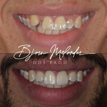 Enamor Dentistry - This difficult Invisalign case was completed in 17 months, the patient had been told by other dentists that his case would require braces. - Cosmetic Dentists Near Me - Scottsdale, Arizona Enamor Dentistry - This difficult Invisalign case was completed in 17 months, the patient had been told by other dentists that his case would require braces. - Cosmetic Dentists Near Me - Scottsdale, Arizona
