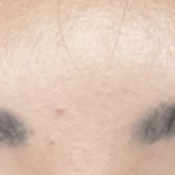 Freedom Laser Hair and Tattoo Removal - Eyebrows before, dark and gray