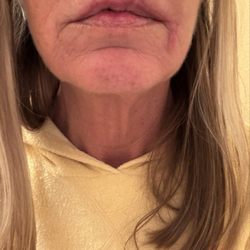 Epiphany Dermatology - Day 14 after MOHS surgery! Unbelievable!!