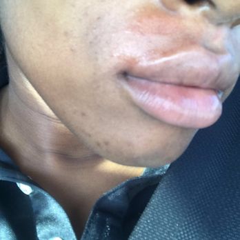 Rapid Wax - Day 1 after the wax - Eyebrow Services Near Me - Miami, Florida