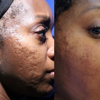 Scar Healing Institute - Severe acne scarring on my right side, which was my worse side. I'm still amazed at my before and after. - Dermatologists Near Me - Beverly Hills, California Scar Healing Institute - Severe acne scarring on my right side, which was my worse side. I'm still amazed at my before and after. - Dermatologists Near Me - Beverly Hills, California