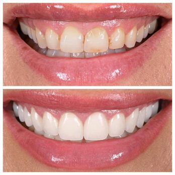Marina Advanced Dentistry - Dental porcelain veneers - Cosmetic Dentists Near Me - Marina del Rey, California