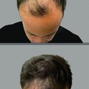 Novare Aesthetics - Stem cell hair treatment using micro needling.  Your natural hair regrows! - Aestheticians Near Me - Westminster, Colorado