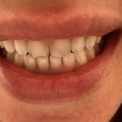 Adriatic Dental - AFTER photo! Front incisors are now dark and lead looking!