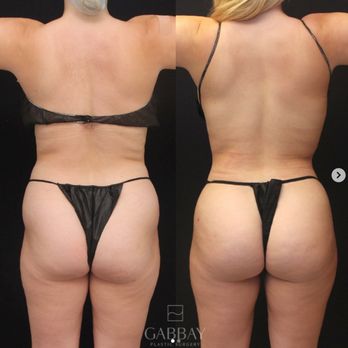 Gabbay Plastic Surgery - Cosmetic Surgeons Near Me - Beverly Hills, California Gabbay Plastic Surgery - Cosmetic Surgeons Near Me - Beverly Hills, California