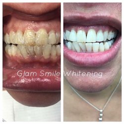 Glam Smile Whitening And Beauty Spa