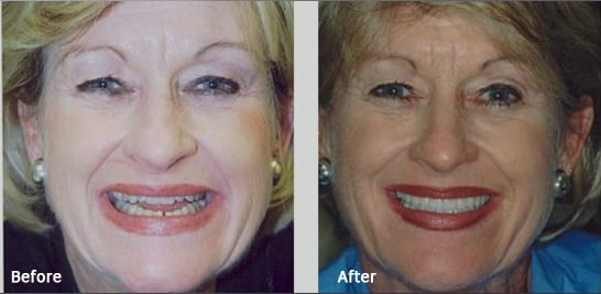 Photo of Palmer Distinctive Dentistry - Greenville, SC, US. Before and after