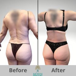 Liposuction Center Moein Surgical Arts - Combination of Vaser liposuction and Tummy tuck