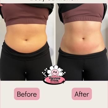 Charming Beauty - Body Sculpting Session one hour after - Body Contouring Near Me - Redondo Beach, California Charming Beauty - Body Sculpting Session one hour after - Body Contouring Near Me - Redondo Beach, California