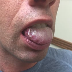 Facial Surgery Center: Curtis J. Bowman - Right side of tongue caught between teeth when my jaw was wired shut. This doctor refused to fix it.