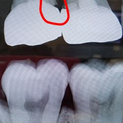 Aspen Dental - This is 9 months after getting a crown from you ppl