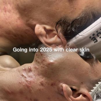 The Vyne - Acne Treatment Near Me - San Diego, California The Vyne - Acne Treatment Near Me - San Diego, California