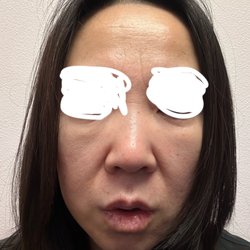 Chase Lay, MD - 11 months after the surgery