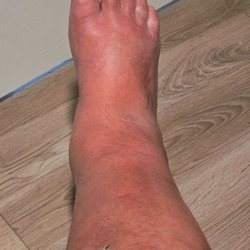 Winnsboro Health Services - My leg the day of my visit.