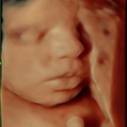 A Glimpse Before & After Ultrasound - 3D/4D/HD Live Ultrasound