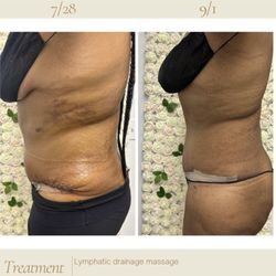 Dolce Beaute - Post Op Care= Lymphatic drainage massage.