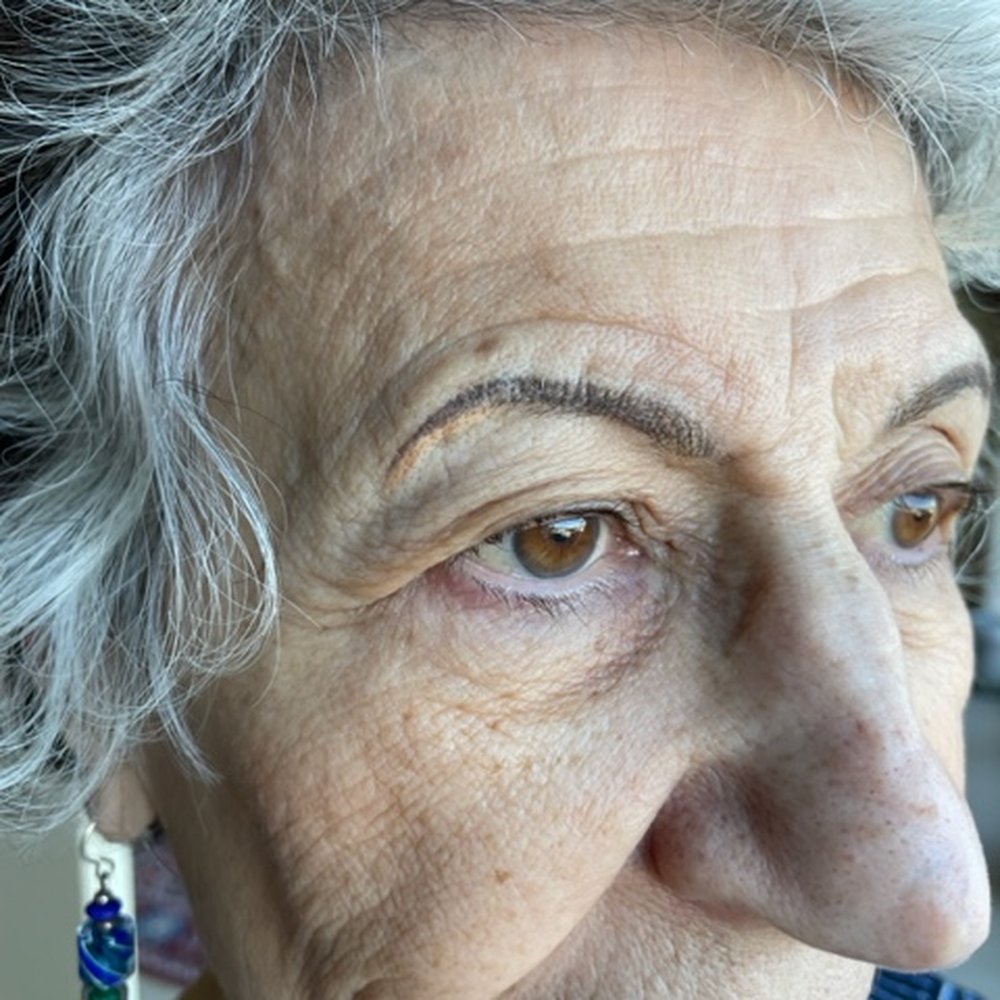 Here is a picture of my brow. What looks like a blister, ismy natural eyebrow, previously tattooed. Here is a picture of my brow. What looks like a blister, ismy natural eyebrow, previously tattooed.