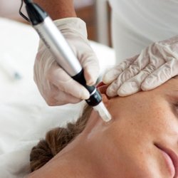 O2 Aspen - Micro Needling