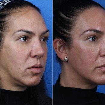 Gotham Plastic Surgery - Before and after - Cosmetic Surgeons Near Me - New York, New York Gotham Plastic Surgery - Before and after - Cosmetic Surgeons Near Me - New York, New York