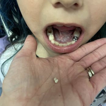 Just For Kids Pediatric Dentistry - Cap falls off - Pediatric Dentists Near Me - Redlands, California Just For Kids Pediatric Dentistry - Cap falls off - Pediatric Dentists Near Me - Redlands, California