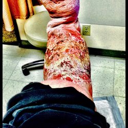 Douglas Freeman, MD - Under the care of Dr Douglas Freeman his ineptness has rendered me wheelchair bound.