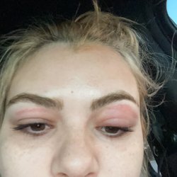 Hello Sugar Orlando Sodo - Swollen eyelids and red marks