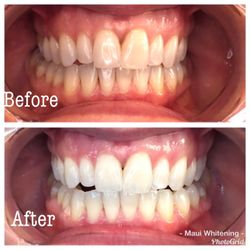 Maui Teeth Whitening And Tanning