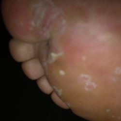 Highland Nails - 2nd foot--athletes feet