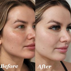 Microneedling with radio frequency before and after