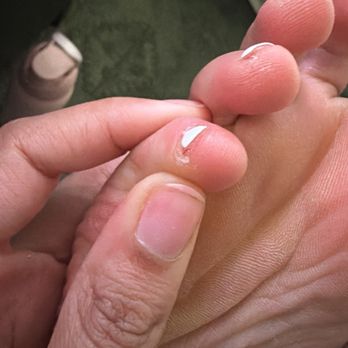 D’Limo Nail Lounge - my wifes toe that was overfiled and cut. - Nail Salons Near Me - Houston, Texas D’Limo Nail Lounge - my wifes toe that was overfiled and cut. - Nail Salons Near Me - Houston, Texas