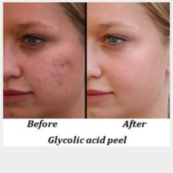 Glycolic Acid peels available