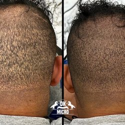 DK SMP - FUE scar cover up with SMP