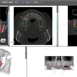 Eternadental - Using a CT scan, we are able to precisely plan the placement of implants