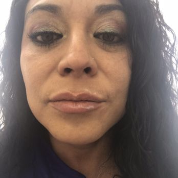 The Skin RN - Immediately after lip filler injections with Restylane and injections on forehead with Dysport. - Medical Spas Near Me - Albuquerque, New Mexico The Skin RN - Immediately after lip filler injections with Restylane and injections on forehead with Dysport. - Medical Spas Near Me - Albuquerque, New Mexico